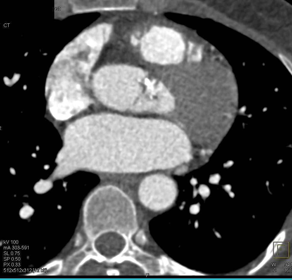 Bicuspid Aortic Valve wth Calcification - CTisus CT Scan