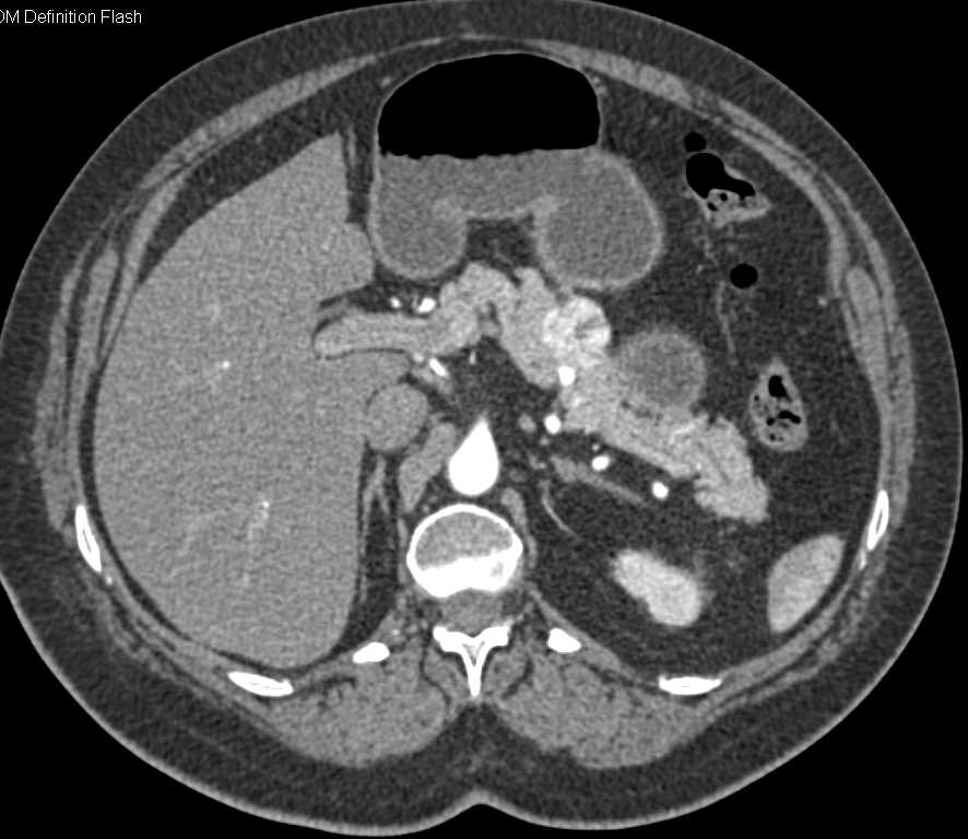 Metastatic Renal Cell Carcinoma to Pancreas and Bone - CTisus CT Scan
