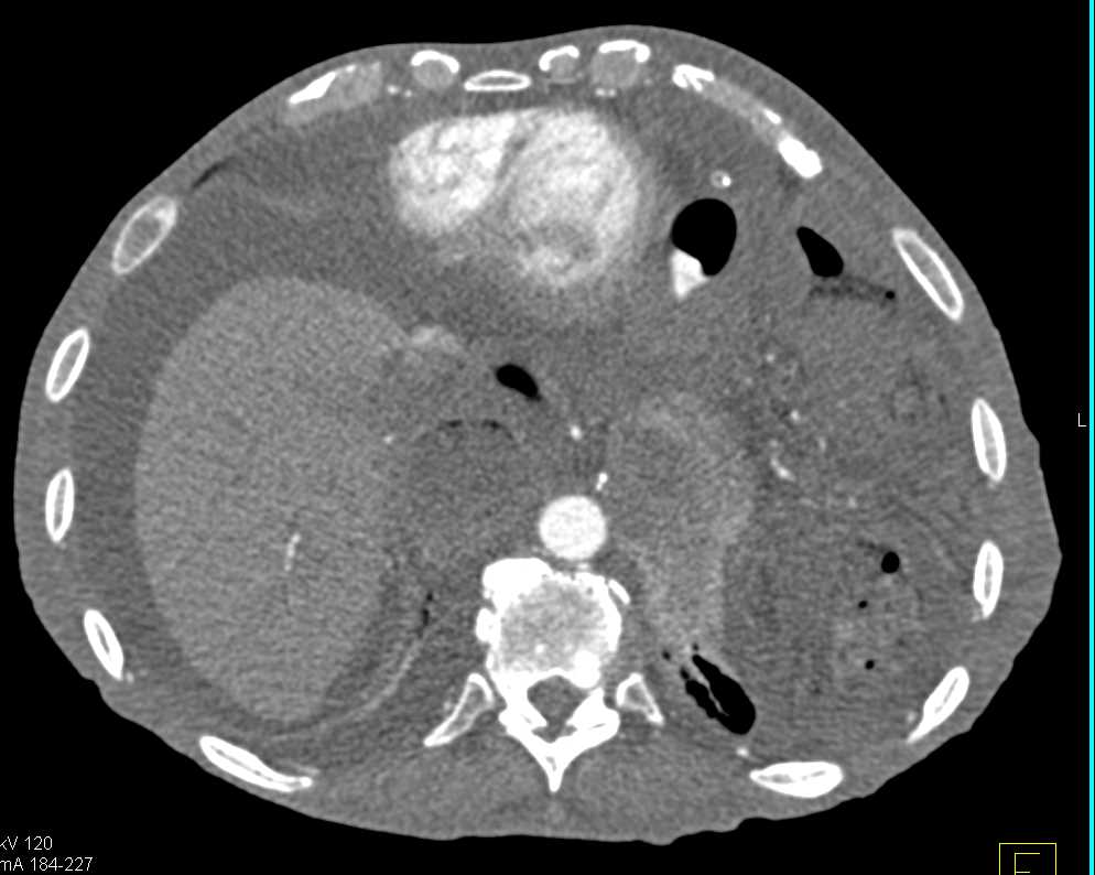 Cirrhosis with Ascites - CTisus CT Scan