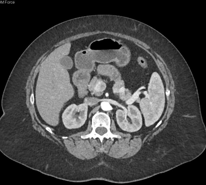 Neuroendocrine Tumor Tail of Pancreas - CTisus CT Scan