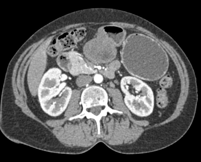 GIST Tumor off Gastric Antrum - CTisus CT Scan